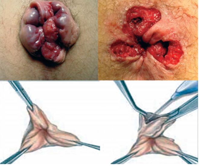 L’hémorroïdectomie classique
